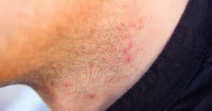 Pimples After Shaving Face