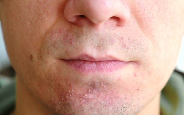 Pimples After Shaving